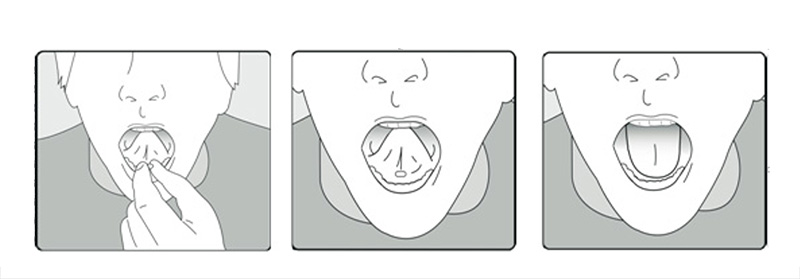Perorální fentanyl - použití